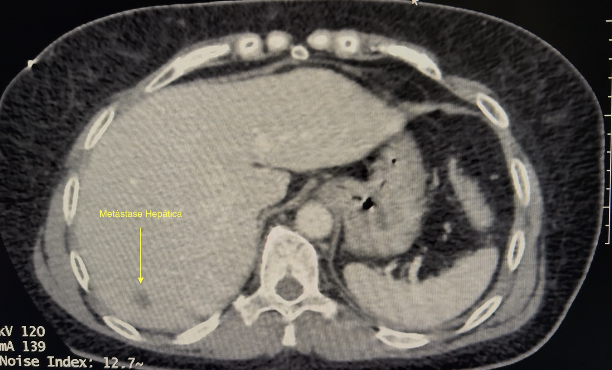 Tomografia computadorizada axial evidenciando metástase hepática hipodensa de 1,5 cm no lobo direito — caso tratado com ablação por micro-ondas guiada por TC