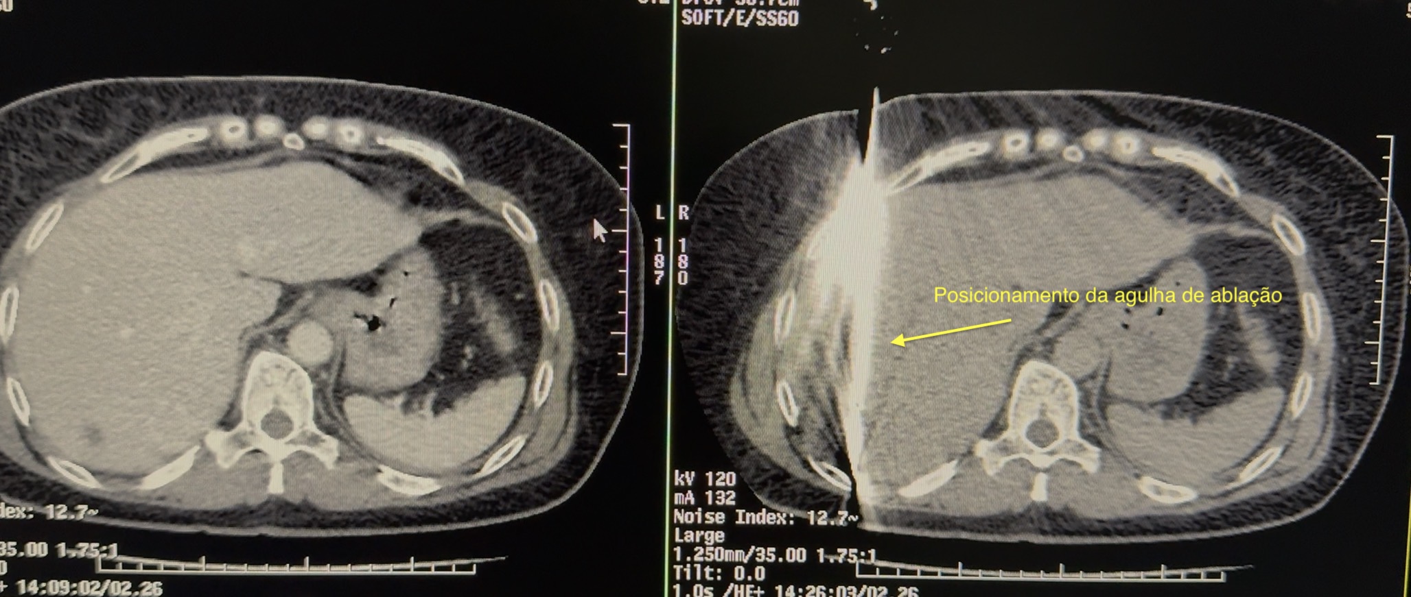 Tomografia computadorizada intraoperatória demonstrando agulha de ablação posicionada dentro do tumor hepático — procedimento realizado pelo Prof. Dr. Edmond Le Campion