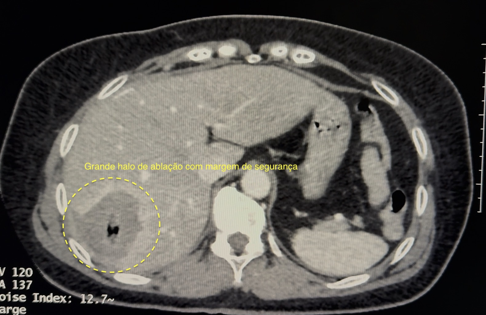 Tomografia computadorizada pós-ablação evidenciando grande halo de necrose com ampla margem de segurança ao redor do tumor — resultado excelente obtido pelo Prof. Dr. Edmond Le Campion