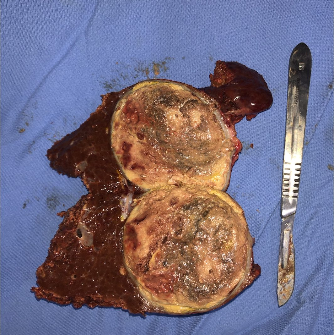 Peça cirúrgica seccionada mostrando o carcinoma hepatocelular no interior do parênquima hepático
