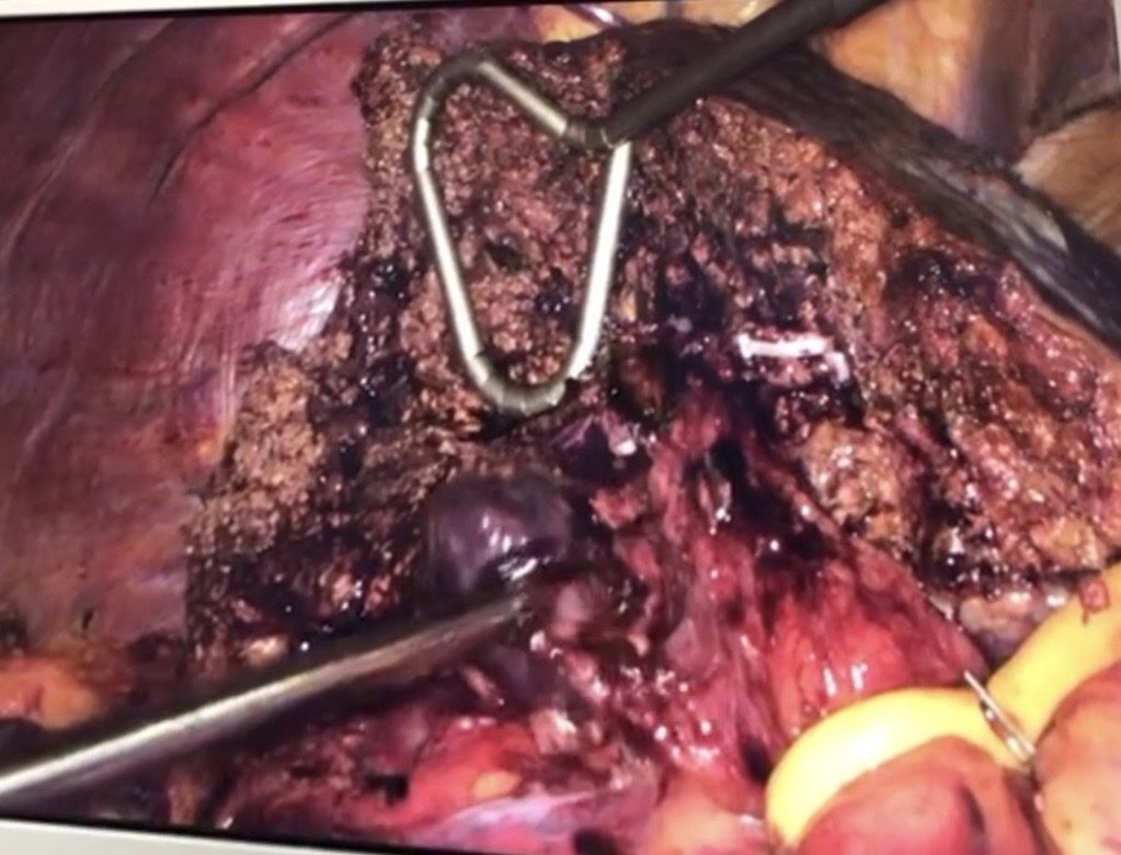 Imagem intraoperatória de hepatectomia direita por videolaparoscopia