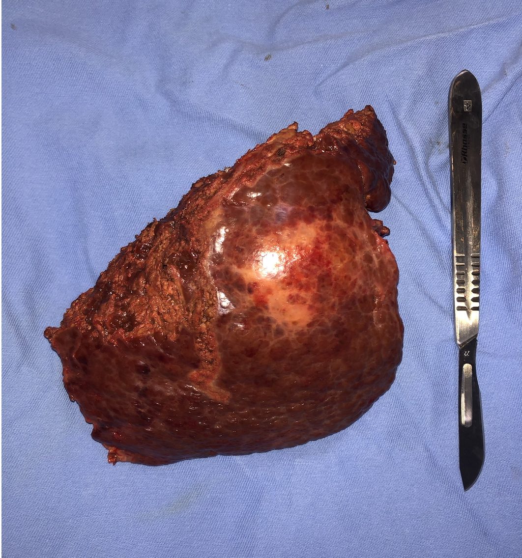 Peça cirúrgica de hepatectomia direita por carcinoma hepatocelular