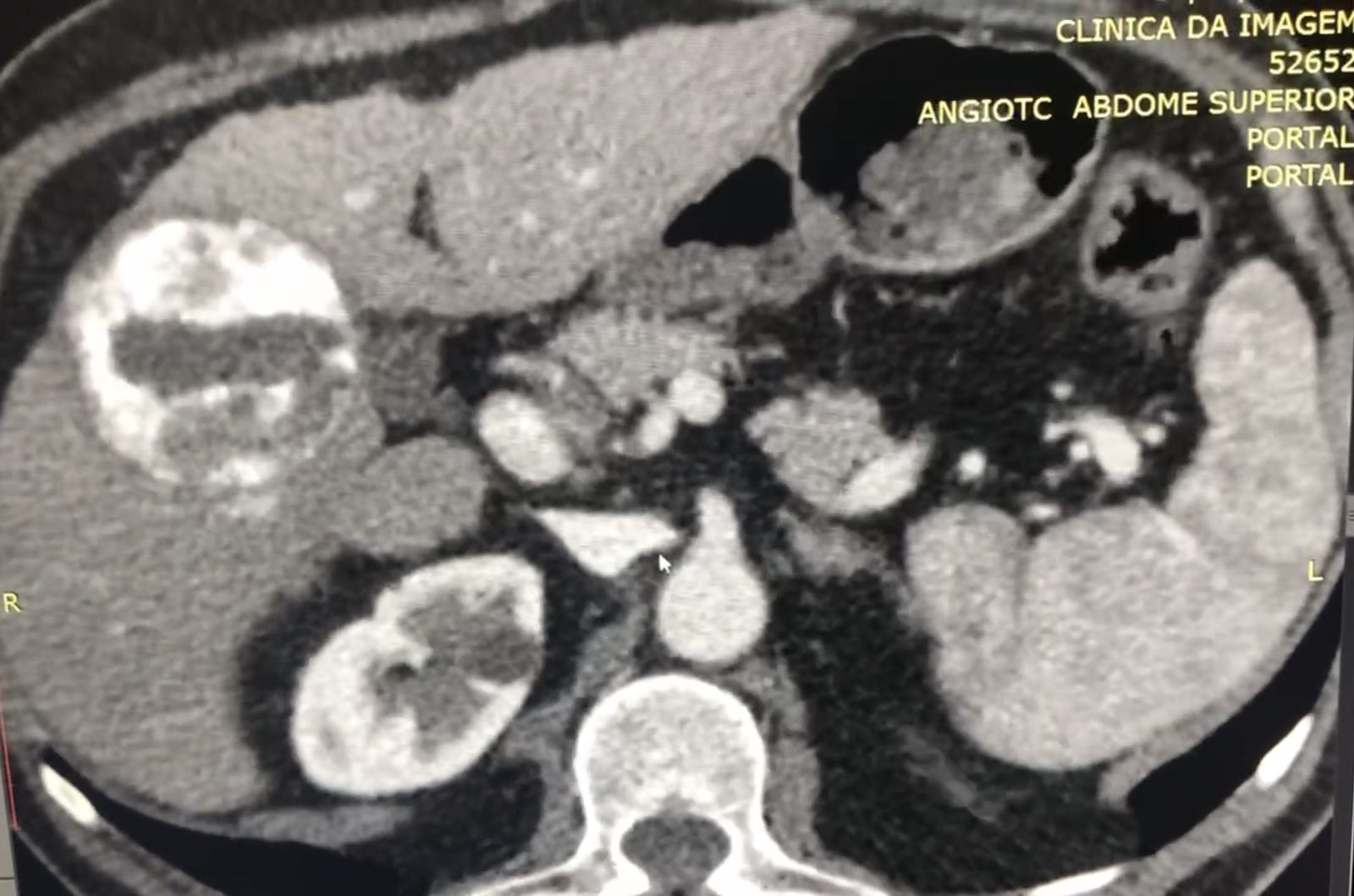 Tomografia axial evidenciando carcinoma hepatocelular após embolização em fígado cirrótico
