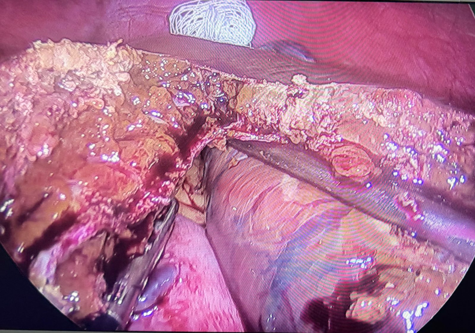 Imagem intraoperatória de setorectomia lateral esquerda por videolaparoscopia
