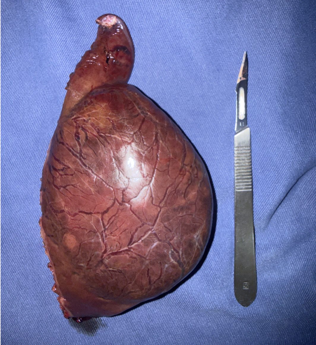 Peça cirúrgica: setor lateral esquerdo do fígado contendo grande adenoma hepático